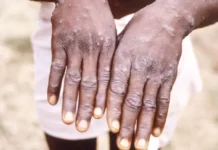 Maymun Çiçeği Virüsü Yeni Salgın mı Olacak? DSÖ Açıkladı! Maymun Çiçeği Virüsü Yeni Salgın mı Olacak DSÖ Açıkladı!