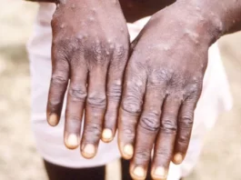 Maymun Çiçeği Virüsü Yeni Salgın mı Olacak DSÖ Açıkladı!