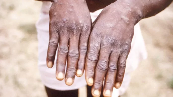 Maymun Çiçeği Virüsü Yeni Salgın mı Olacak DSÖ Açıkladı!