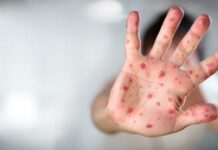 DSÖ Maymun Çiçeği için küresel acil durum kararı aldı! DSÖ Maymun Çiçeği için küresel acil durum kararı aldı!