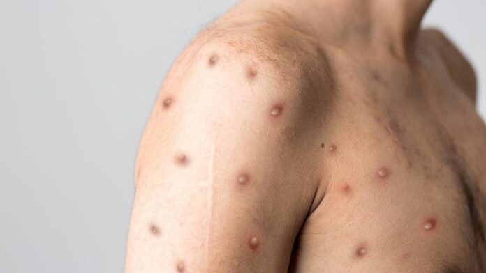 Tayland’ın ilk maymun çiçeği hastası komşu ülkeye kaçtı! Tayland’ın ilk maymun çiçeği hastası komşu ülkeye kaçtı!