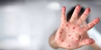 Maymun çiçeği ABD’nin tüm eyaletlerine yayıldı!